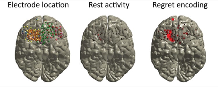 Activity in the orbitofrontal cortex during a gambling experiment, as recorded by electrode meshes placed directly on the surface of the brain. 